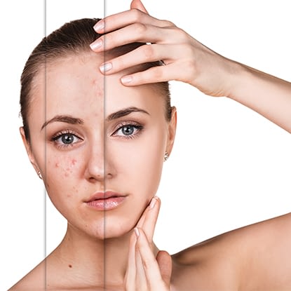 A woman's skin before and after getting skin treatments